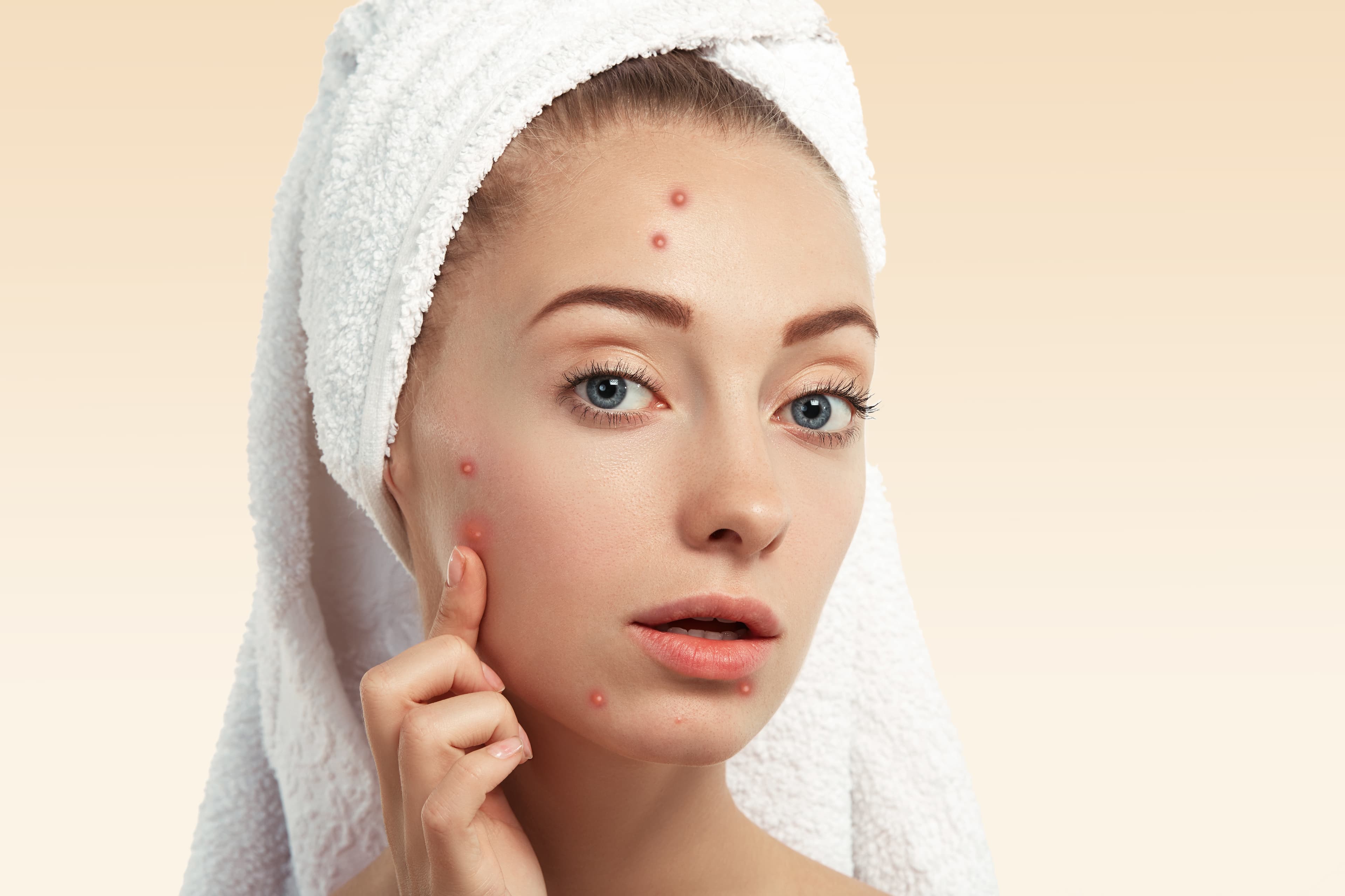 New Look Ask a Q- Is My Skin Purging or Just Breaking Out? blog